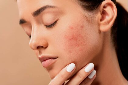 Hormonal vs. Bacterial Acne